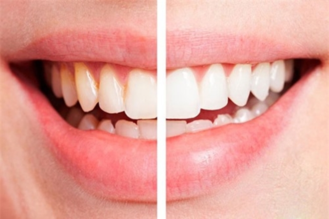 7 thực phẩm làm thay đổi màu răng bạn