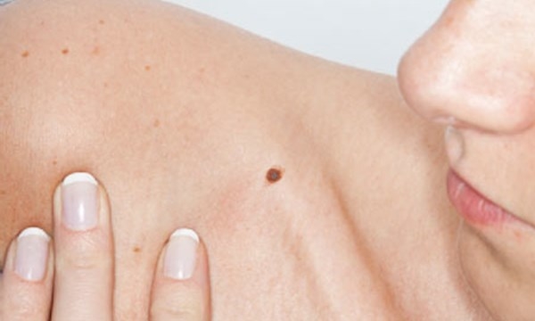 Bói vui: nhận diện 20 vị trí nốt ruồi may mắn trên cơ thể bạn gái