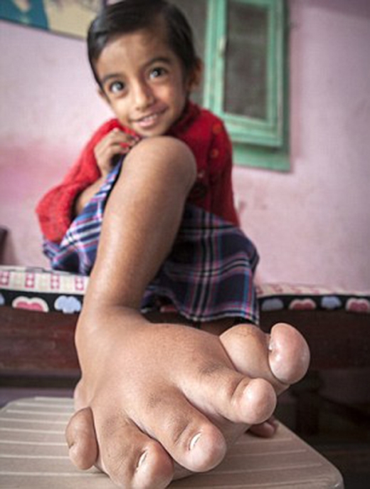Cậu bé Verdan Joshi bị bắt nạt từ hồi còn nhỏ vì chân to. (Ảnh: Internet)