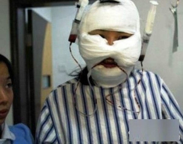 Người phẫu thuật chuyển giới gọt cằm để có gương mặt thon gọn V-line. (Ảnh: Internet)