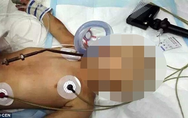 Tai nạn kinh hoàng: Em bé bị que đâm xuyên từ miệng qua não
