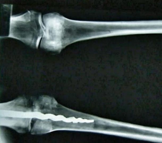 Làm sao người ta có thể đưa cây kim vào trong xương cách đây 3000 năm?