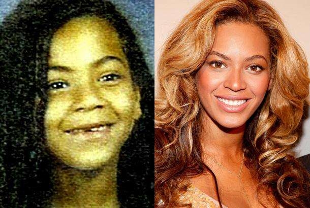 Có lẽ nhan sắc của Beyoncé chỉ thực sự thay đổi khi cô hoàn tất công cuộc thay răng.