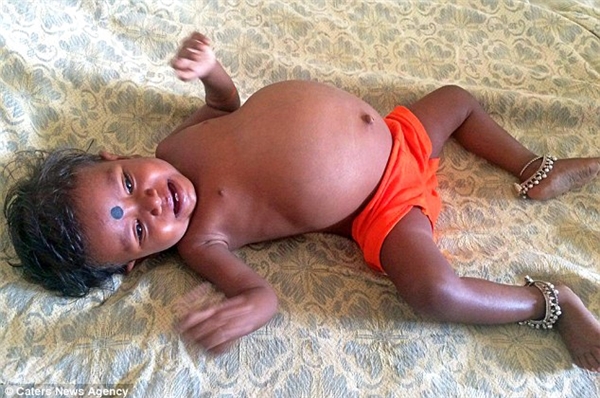 Bé gái 15 tháng tuổi "mang bầu" nặng 3.5kg ở Ấn Độ.