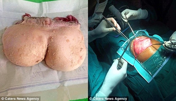Ca phẫu thuật kéo dài và phức tạp hơn dự tính nhưng đã thành công. Bào thai nặng 3.5kg được đưa ra từ trong bụng bé Nisha.