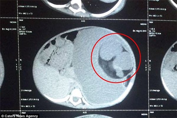 Hình ảnh siêu âm cho thấy bào thai đang nằm trong bụng bé Nisha.