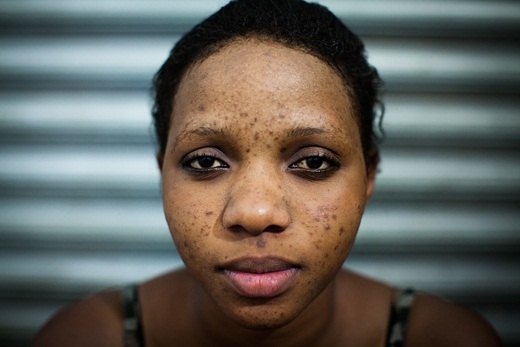 Aisha đắp mặt nạ ở thẩm mĩ viện. Trong vòng hai tháng, các mụn viêm nổi lên khắp mặt.
