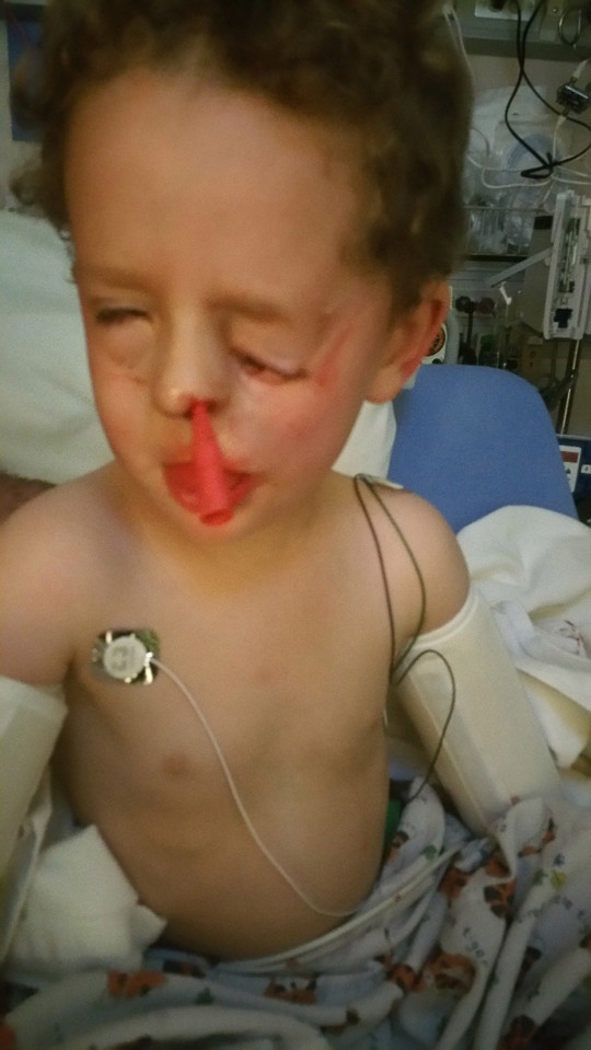 Cậu bé đã phải trải qua 5 lần phẫu thuật để cứu chữa mắt trái, làm mất hố trên khuôn mặt và mở ra khoang mũi.