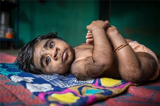 Em bé "ma sói" 5 tháng tuổi tại Ấn Độ