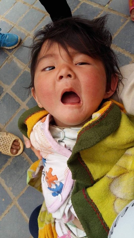 Hình ảnh mới của bé gái Lào Cai 14 tháng tuổi nặng 3,5kg sau hơn 3 tháng được mẹ nuôi chăm sóc