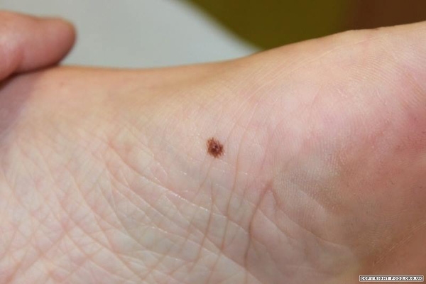 Khi nốt ruồi mọc ở các vị trí trên thì nó có thể là dấu hiệu của khối u ác tính như ung thư da.(Ảnh: Internet)