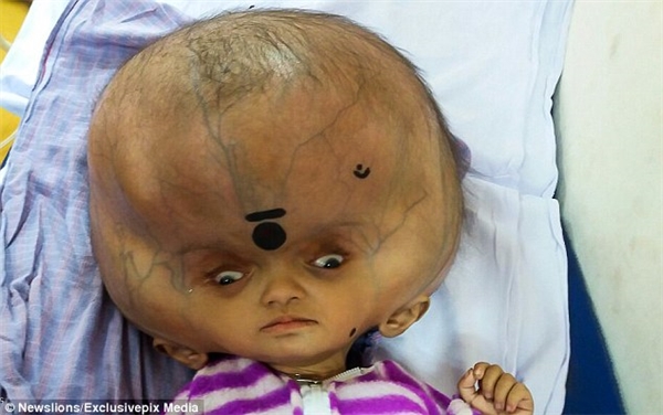 Cuộc đời trớ trêu, Mrityunjay dù chỉ mới 7 tháng tuổi nhưng đã mắc phải chứng não úng thủy khiến đầu em bị đột biến, nở to một cách kì lạ.