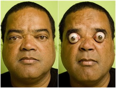 Claudio Pinto ở Brazil nổi tiếng với khả năng làm lồi cặp mắt ra ngoài hốc mắt 4 cm.