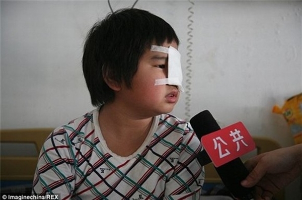 
	
	Bé trai cho biết sau khi bị tát mắt trái đã không nhìn thấy rõ.