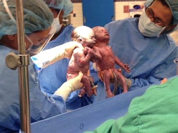 Ngỡ ngàng cặp sinh đôi nắm tay nhau sau khi ra đời