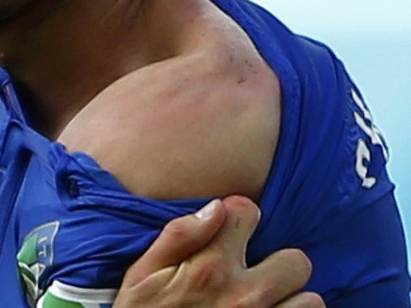 
	
	Vết thương để lại sau phát cắn nổi tiếng của Luis Suarez