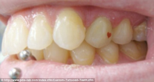 Cảnh báo về độ nguy hiểm của trào lưu “xăm răng”