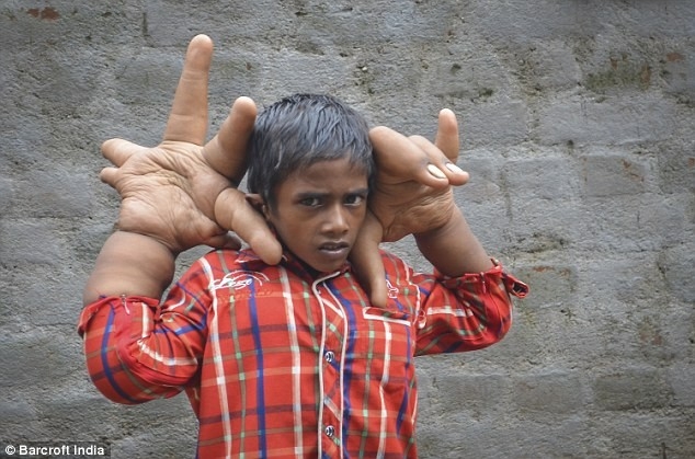 
	
	Bé Kaleem người Ấn Độ mắc căn bệnh lạ khiến đôi tay của em liên tục phát triển dù chúng to hơn đầu cậu bé và nặng như hai tảng đá.