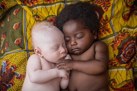 
	
	Em bé 3 tuần tuổi ở Kinshasa, Congo bị chứng bạch tạng đang ngủ yên bình bên chị họ của mình