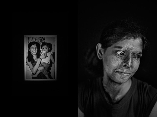 
	
	Đây là chân dung của một nạn nhân bị tạt axit ở Ấn Độ. Bức ảnh bên trái là chân dung trước khi cô gái gặp nạn. 