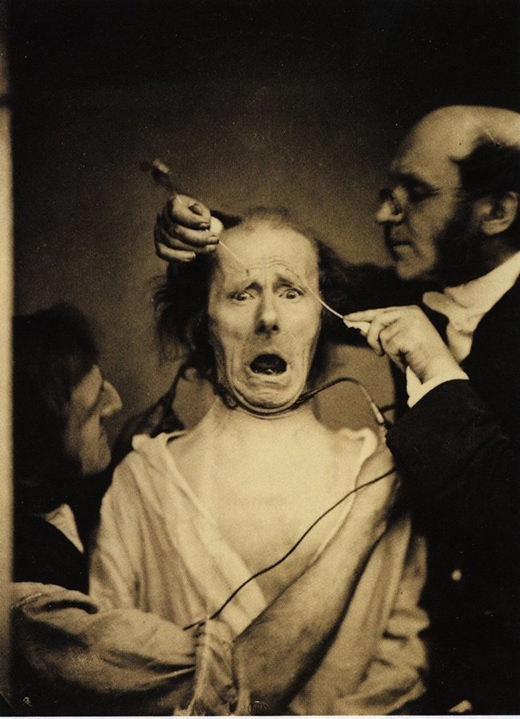 
	
	Nhà thần kinh học Neurologist Duchenne de Boulogne đang nghiên cứu cơ mặt của một người đàn ông.