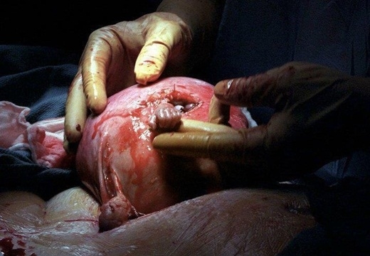 
	
	Bức ảnh với tựa đề “Bàn tay hi vọng” chụp lại khoảnh khắc một em bé chưa ra đời thò bàn tay của mình ra khỏi tử cung của người mẹ và nắm lấy tay bác sĩ. Vị bác sĩ phẫu thuật đã rất ngạc nhiên. Ông đã khóc vì xúc động và không thể nói hay làm bất cứ điều gì trong mấy phút liền.