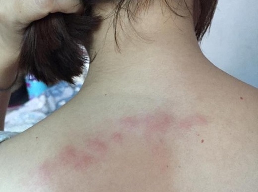 
	
	Chị Thanh Thúy cho biết những vết cắn này gây mẩn ngứa rất khó chịu.