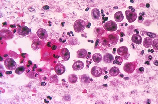 
	
	Naegleria fowleri là một loại amip ăn não. Chúng có thể xâm nhập vào cơ thể bạn khi bơi và uống nước ở ao hồ.