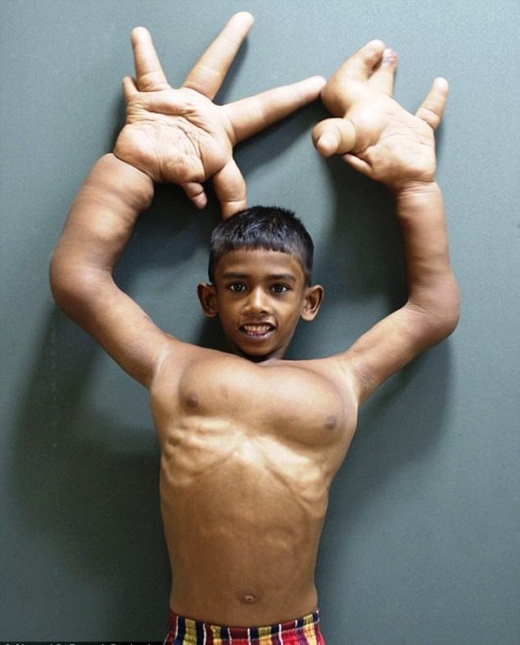 
	
	Theo Globaltimes, cậu bé Mohammad Kaleem 8 tuổi bị một chứng bệnh hiếm khiến bàn tay phát triển bất thường. Mỗi bên tay nặng 8kg. Vì căn bệnh này, em bị bạn bè dè bỉu, người dân trong làng gọi là 'ma quỷ' và không dám lại gần.