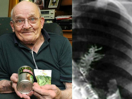 
	
	Ông Ronan Svedan ở bang Massachusetts, Mĩ đã trải qua những cơn ho dữ dội khiến ông phải đến khám bác sĩ. Kết quả chụp X-quang khiến các bác sĩ và ông Ronan hết sức bất ngờ khi phát hiện một cây đậu nhỏ xíu đang phát triển bên trong phổi của ông.