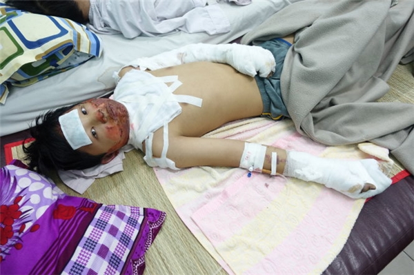 
Em Nguyễn Xuân Thành bị mẹ đốt phỏng độ 4 - Ảnh: M.Vinh