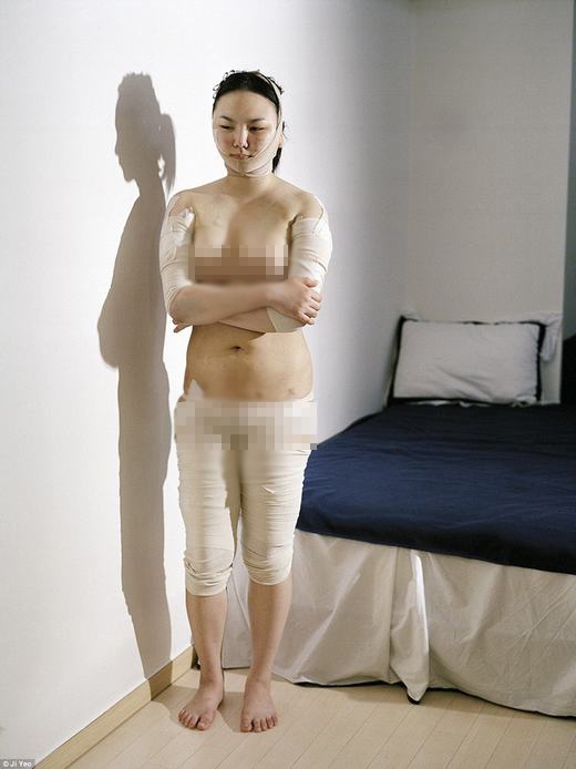 
Một phụ nữ phẫu thuật thẩm mĩ vì mặc cảm với cơ thể xấu và có phần mập mạp của mình. (Ảnh: Ji Yeo)