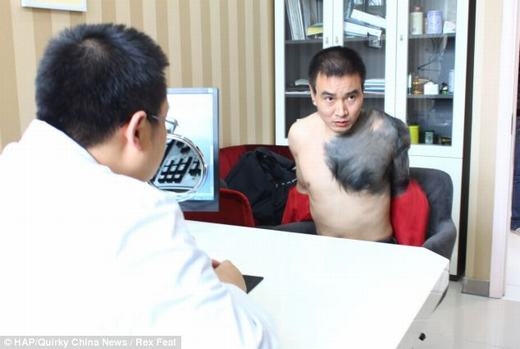 
Người đàn ông này có tên là Zhang Hongming, sống tại Trùng Khánh, phía đông nam Trung Quốc. Ông có biệt danh là "tinh tinh” bởi vết bớt kèm rất nhiều lông, chiếm hơn 1/3 cơ thể, kéo dài từ trước ra sau. Được biết, tỉ lệ những người bị vết bớt như Zhang chỉ chiếm không quá 3% dân số thế giới. (Ảnh: Internet)