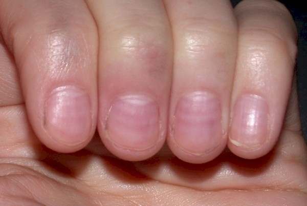 Màu móng tay tiết lộ gì về các bệnh tật của bạn?