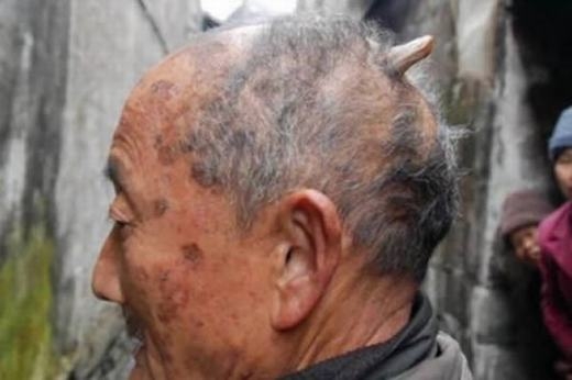 
Ông Huang Yuanfan, 84 tuổi, sống tại Ziyuan, miền nam Trung Quốc đã mọc một chiếc sừng phía sau đỉnh đầu. Tuy không lớn bằng chiếc sừng của cụ Liang nhưng nó dài đến 3 inch (khoảng hơn 7,5cm) và không ngừng phát triển thêm. “Các bác sĩ không biết tôi bị bệnh gì. Tôi phải che nó đi bằng mũ nhưng có lẽ sẽ khó làm điều đó trong tương lai”, ông nói. (Ảnh: Oddee)