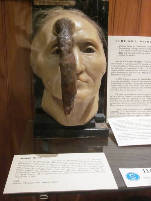 
Quay trở về những năm đầu thế kỉ 19, đã có một phụ nữ tên là Dimanche, hay còn gọi là Widow Sunday, người Pháp sở hữu chiếc sừng dài lên tới 24,9 cm ở giữa trán. Hiện mô hình sáp về chiếc đầu mọc sừng của cô đang được trưng bày tại Bảo tàng Mutter tại The College of Physicians của Philadelphia. (Ảnh: Oddee)
