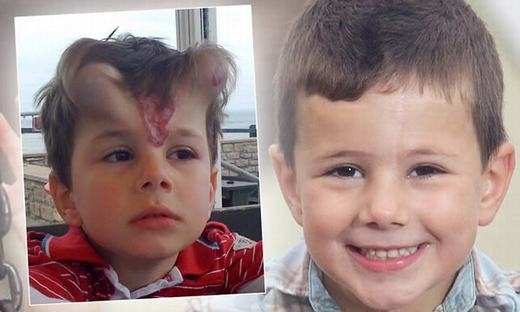 
Cậu bé George Ashman, 5 tuổi này đã bị một vết bớt lớn ở giữa khuôn mặt. Các bác sĩ đã phẫu thuật loại bỏ nó bằng cách tăng thể mô dưới da cho cậu. Kết quả là hai bên trán nổi lên các u giống chiếc sừng. Tất nhiên là nó sẽ xẹp xuống vài tháng sau đó. (Ảnh: Oddee)