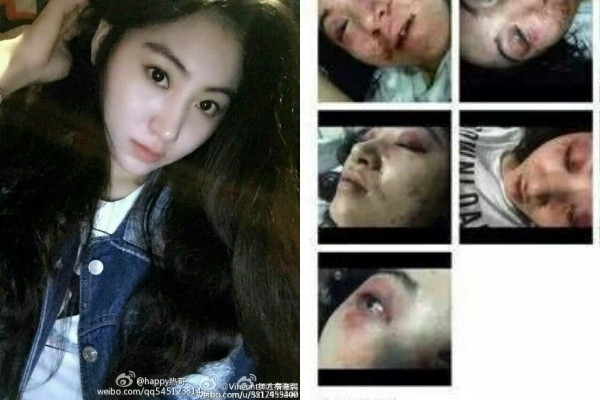 
Nữ ca sĩ Tiểu Hy bị đánh đập đến biến dạng mặt chỉ vì cãi lời ông chủ. Sự việc xảy ra vào giữa năm 2015.