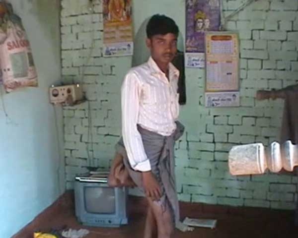 
Chàng trai 20 tuổi có 4 chân ở Ấn Độ. Ảnh: Internet