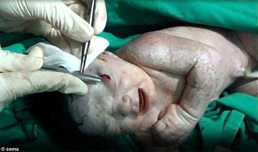 
Một bé gái ở Syria chào đời với một mảng đạn dính vào mặt sau khi người mẹ đi vào vùng không kích tên lửa. Một mảnh đạn bắn vào bụng cô, đâm thủng tử cung và làm đứa bé bị thương. Các bác sĩ phải tiến hành mổ gấp, và cô bé được lấy viên đạn ra khỏi đầu an toàn. Sau đó cô bé được đặt tên là Amel, trong tiếng Ả-rập có nghĩa “Hi Vọng”. (Ảnh: Medical Daily)