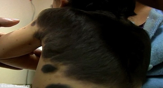 
Cậu bé 1 tuổi người Trung Quốc từ khi sinh ra đã nhiễm căn bệnh da mọc lông hiếm gặp. (Ảnh: Newsflare)