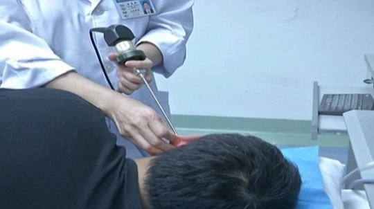 
Các bác sĩ tiến hành lấy "ổ giòi" ra khỏi lỗ tai cho người đàn ông này. Ảnh: Internet