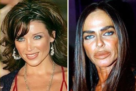 
Michaela Romanini nghiện tiêm collagen và botox để căng da cũng như làm cho đôi môi của mình gợi cảm hơn. Tuy nhiên, việc lạm dụng chúng đã khiến cô phải trả giá bằng chính nhan sắc của mình. (Ảnh: Internet)