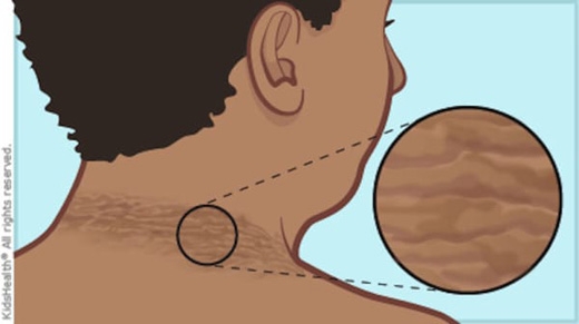 
Theo các chuyên gia, vòng tròn sẫm màu trên cổ chính là biểu hiện của tiểu đường loại 2. (Ảnh: littlethings)
