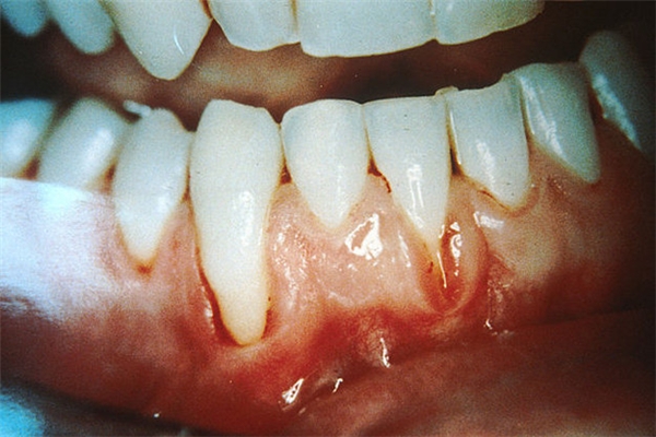 
Các bệnh về nướu răng sẽ làm bạn đau đớn. (Ảnh: Internet)