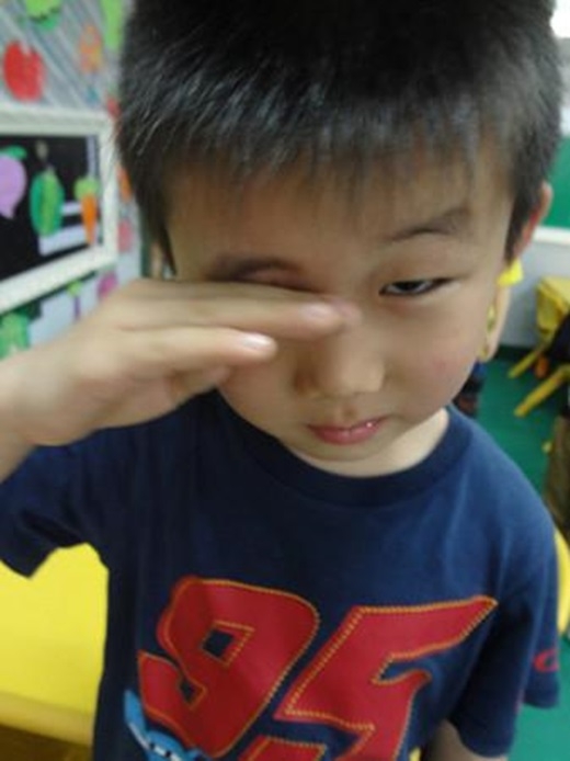 
Trường hợp năm ngoái của cậu bé 8 tuổi tại Giang Tô, Trung Quốc cũng tương tự khi bị bỏng mắt vì gói hút ẩm. Được biết, cậu bé được mẹ thưởng cho rất nhiều đồ ăn vặt như bim bim… vì có thành tích học tập giỏi. (Nguồn Internet)