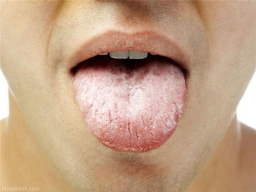 
Nấm miệng: nếu trên lưỡi có màu trắng kem, giống như pho mát, và cạo bị chảy máu, thì bạn đã bị nấm miệng. Đây có thể chính là phản ứng do thuốc kháng sinh gây ra. Bạn nên thường xuyên súc miệng bằng nước muối ấm.