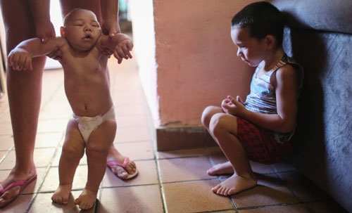
Những đứa trẻ tội nghiệp bị teo não do virus Zika gây ra. Ảnh: Internet