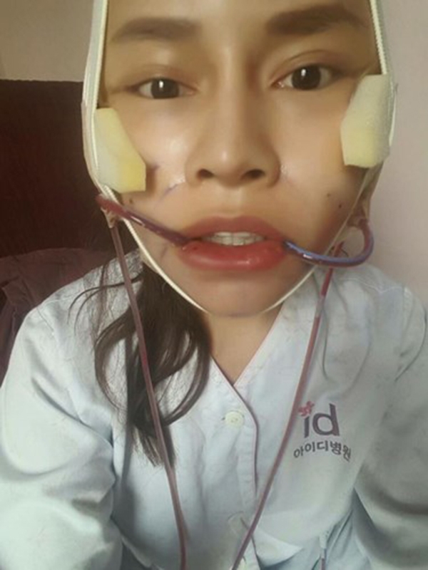 
Gương mặt đang được "trùng tu" sau quá trình phẫu thuật thẩm mĩ của Vanrisa. (Ảnh: Internet)