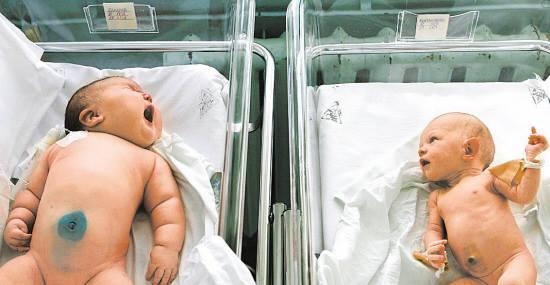 
Em bé nặng nhất thế giới có số cân gấp 6 lần trẻ sơ sinh bình thường. (Ảnh: Internet)
